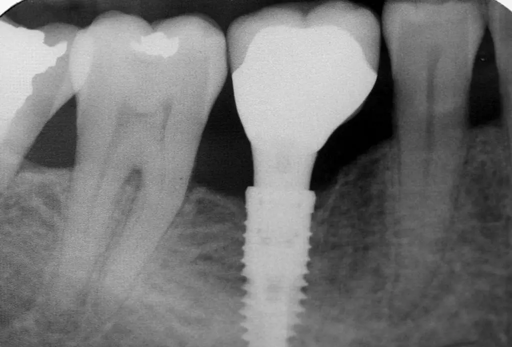 Quel est le prix des implants dentaires au Maroc en 2026 ?
